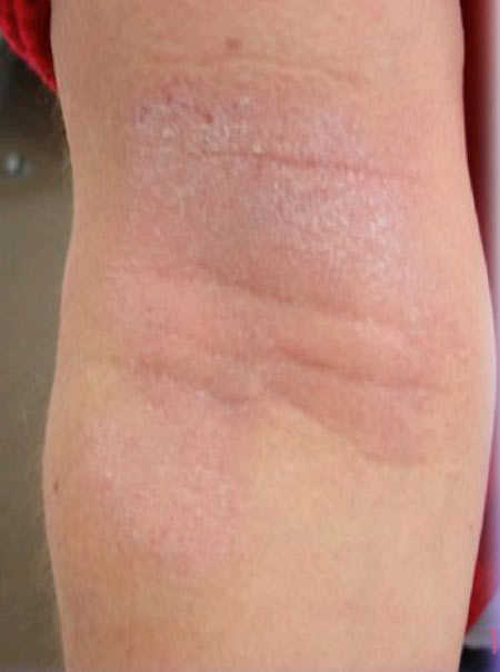 eczema-bras-avant-après-séance-de-photobiomodulation-cabine-à-leds-avant-450x604