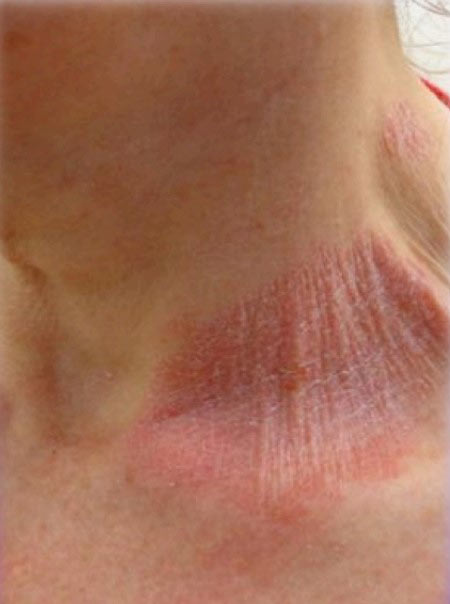 eczema-cou-avant-après-séance-de-photobiomodulation-cabine-à-leds-avant